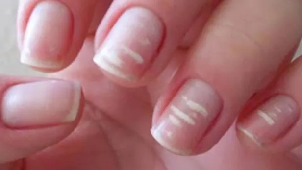 tirnaklardaki-beyaz-cizgilerin-nedeni-meger-buymus-herkes-farkli-biliyordu-meger-1697460204561.jpg Tırnaklardaki beyaz çizgilerin nedeni meğer buymuş! Herkes farklı biliyordu: Duyunca çok şaşıracaksınız!-2
