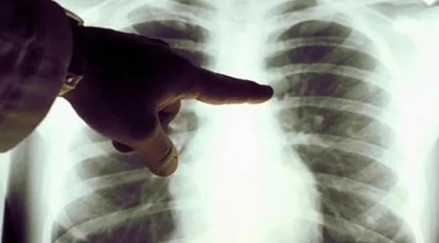 oksuruge-ne-iyi-gelir-evde-kuru-ve-balgamli-oksuruk-nasil-gecer-bebek-cocuk-ve-hamileler-icin-en-hizli-dogal-c-1647639174917.jpeg Bebek, çocuk ve hamileler için en hızlı öksürüğe doğal çözümler! 📌ÖKSÜRÜĞE NE İYİ GELİR? Evde kuru ve balgamlı öksürük nasıl geçer?-7