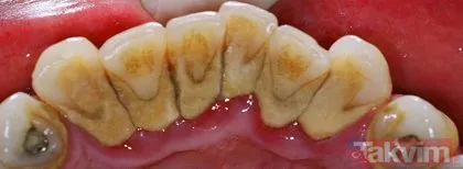 Diş taşı nasıl geçer? İşte diş taşlarını temizleyen mucizevi yöntem!