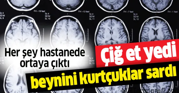 Çiğ et yedi tüm beynini tenyalar sardı