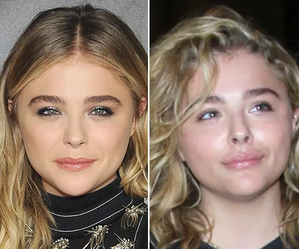 Aleyna Tilki yüzüne ne yaptırdı?-9