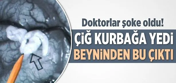 Kurbağa yedi beynine tenya bulaştı