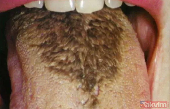 Akılalmaz hastalık doktorları bile şoke etti! Ağzının içinde bir anda başladı şimdi bakmak cesaret ister - 5