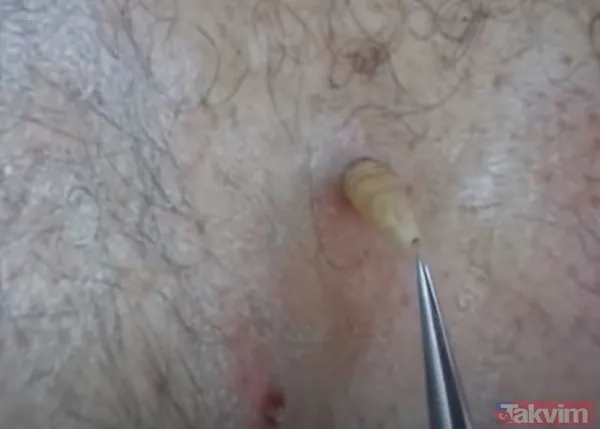 Karnındaki şişlik için gitti içinden çıkan doktorları bile şoke etti! Yer uzak değil Kayseri! 64 kilo girdi 55 kilo çıktı - 44