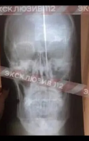 Rusya'da nefes alamayan adam kafasını deldi