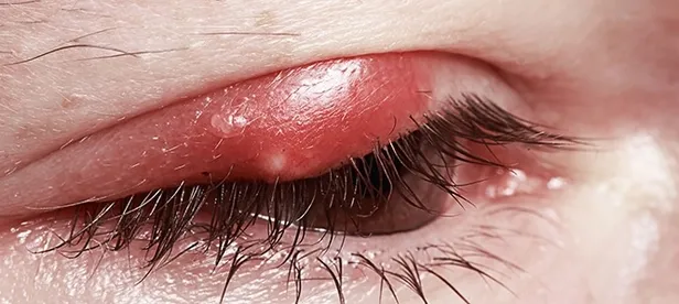 Hemen geçirin! ARPACIK NEDEN OLUR? Arpacığa ne iyi gelir? Arpacık nasıl geçer?-4