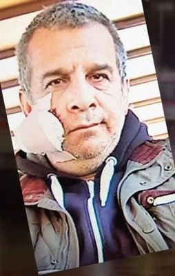"Isırık" vakası