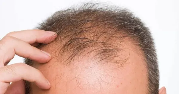 Rüyada kel olduğunu görmek ne anlama gelir, neye işarettir? Rüyada