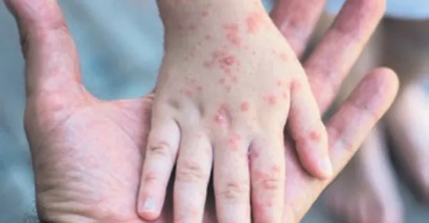 El ayak ağız hastalığında ebeveynlere 5 kritik uyarı
