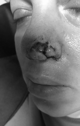 Yürüyüş yaparken pitbull saldırısına uğradı! Burnu parçalandı