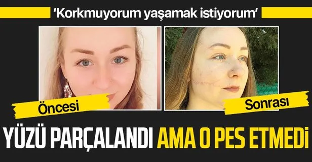 Eşi falçatayla saldırdı Ukraynalı Hanna Butym’un yüzünün bir kısmı felç kaldı!