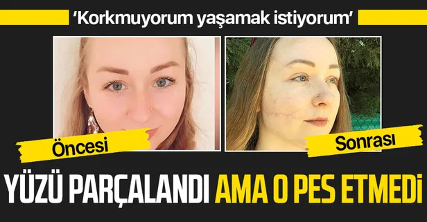 Eşi falçatayla saldırdı Ukraynalı Hanna Butym'un yüzünün bir kısmı felç kaldı!