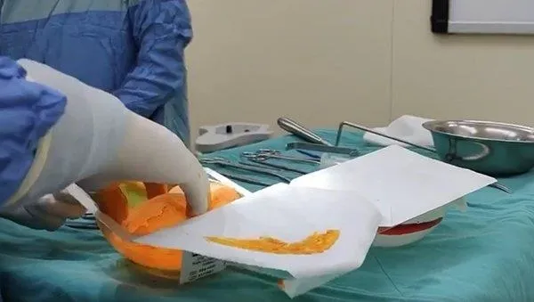 SON DAKİKA: İstanbul'da 'kalça estetiği' faciası: Brezilya kalçası istedi ölümden döndü-6