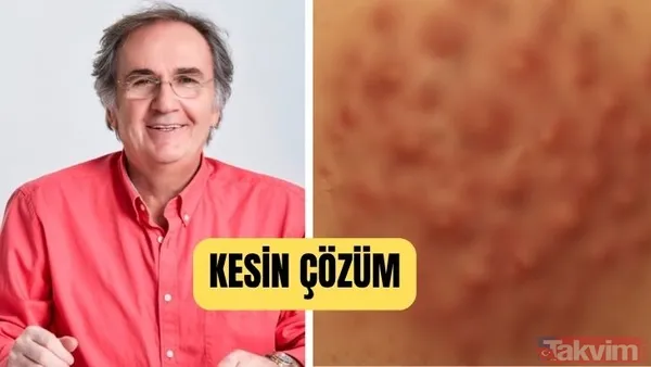 Prof. Saraçoğlu’ndan Kıl Kökü İltihabına Kesin Çözüm - 1