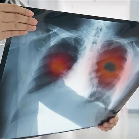 Akciğer kanseri keser nefesi