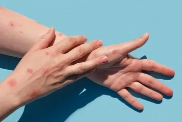 Maymun Çiçeği alarmı sonrasında herkes bunu araştırıyor! Çiçek aşısı nedir? Çiçek aşısı Türkiye'de yapılıyor mu? İşte çiçek aşısı ve Osmanlı...