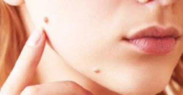 Vücudunuzdaki benler bazı tehlikelerin habercisi