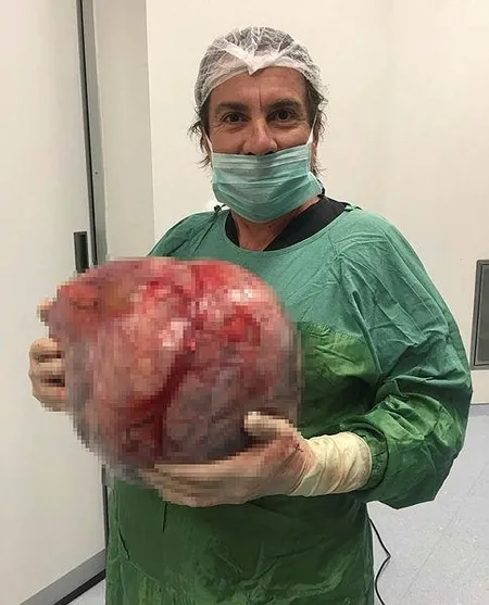 Kilo aldığını sanan yaşlı kadının karnından 12 kilogram ağırlığında yumurtalık kisti çıkartıldı-2