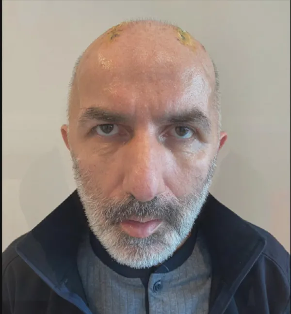 kafatasi-kemiklerini-5-ay-karninda-tasidi-sagligina-kavustu-1626078503478.jpg Kafatası kemiklerini 5 ay karnında taşıdı! Sağlığına kavuştu-5