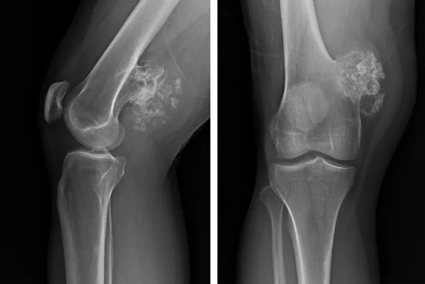 sislik-deyip-gecmeyin-kemik-tumoru-habercisi-olabilir-1674001192551.jpeg Şişlik deyip geçmeyin! Kemik tümörü habercisi olabilir-3