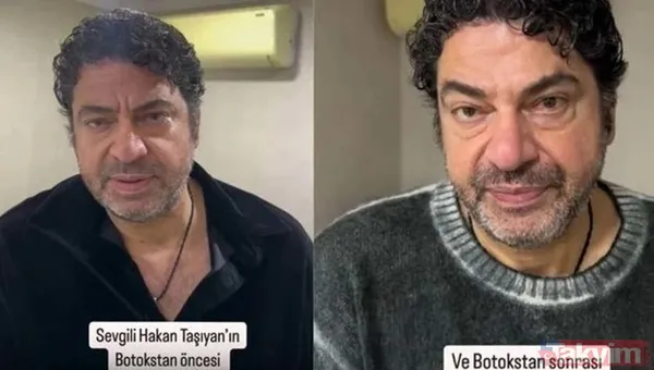 Alişan'dan botoks itirafı! İşte estetik yaptıran erkek ünlüler - 6