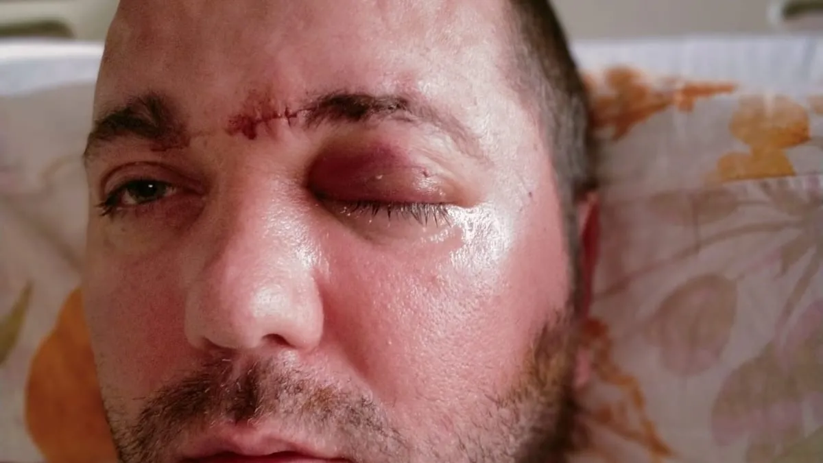 İmplant için gitti ölümden döndü! ABD dergilerine bile konu olan olay! Vida çene kemiğini delip beynine saplandı