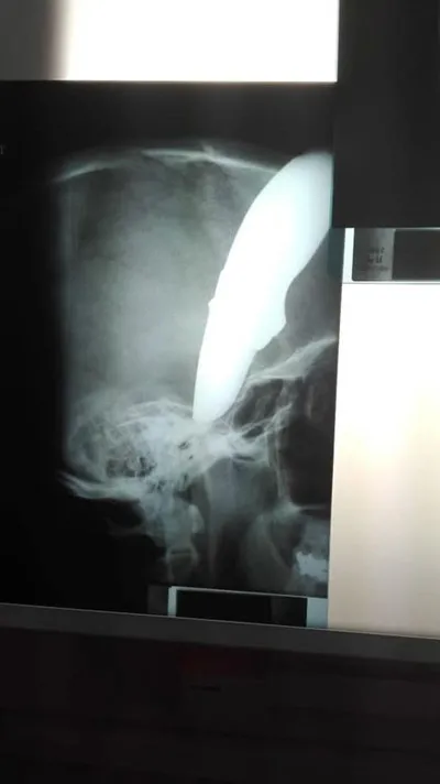 Başına saplanmış 15 cm'lik bıçakla kurtuldu! - 2