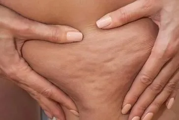 Uzmanı tüm detayları anlattı: Baş belası selülitten nasıl kaçınılır? Hangi besinler tüketilmeli?