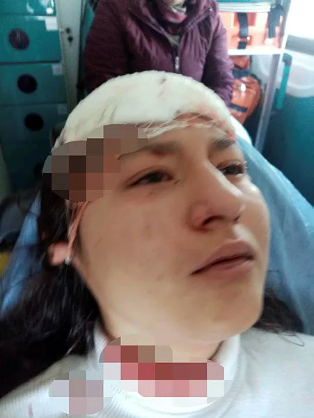 2. Asiye Ateş vakası! Kastamonu'da sokak köpekleri selfie yapan genç kızın yüzünü parçaladı-3