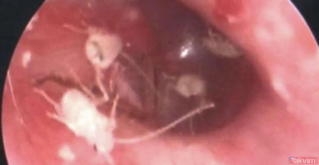 Kulağından çıkanlar şoke etti! Korkunç, görenler inanamadı… Doktorlar