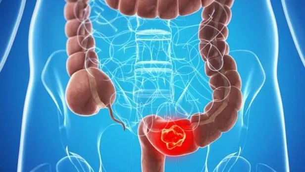 kilo-kaybi-ve-sariliga-yol-acan-kolon-kanserinde-duzenli-kontrol-buyuk-onem-tasiyor-1650916911933.jpeg