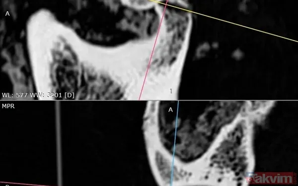 Antik çağın cerrahları: 2.500 yıllık mumyada at kılından yapılan protez keşfedildi - 5