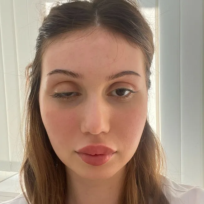 Botoks faciası