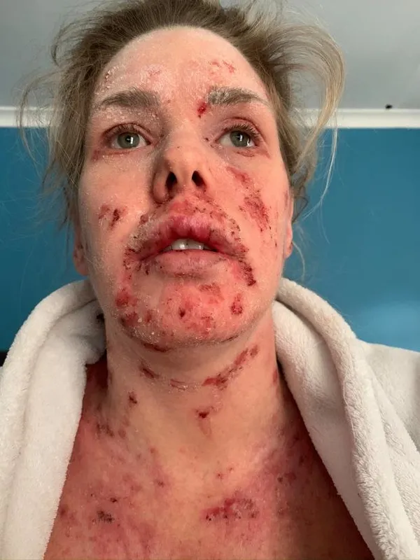 Güney Afrika’da yaşayan Samantha Saunders'ın hayatı bir krem ile değişti! Sebebini öğrenenler şoke oldu-9