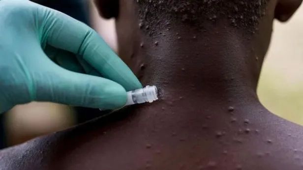 bakan-koca-uyardi-maymun-cicegi-virusu-turkiyede-hangi-ilde-goruldu-maymun-cicegi-virusu-belirtileri-neler-nas-1656572257216.jpg BAKAN KOCA UYARDI! Maymun Çiçeği Virüsü Türkiye'de hangi ilde görüldü? Hangi hastanede? Maymun Çiçeği virüsü belirtileri neler, nasıl bulaşır?-4