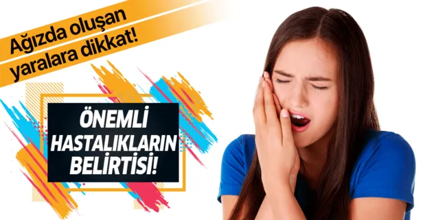 Ağız yaraları önemli hastalıkların belirtisi! Ağız yarası nedir? Ağız yarası belirtileri nelerdir?