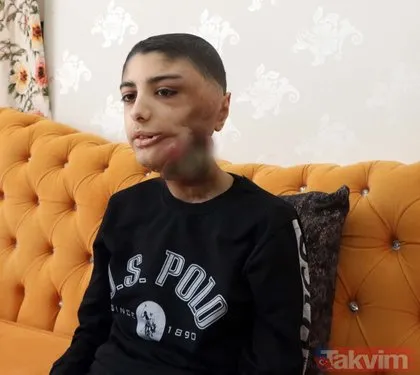 Çaresizliğin karesi! Yüzündeki tümör nedeniyle yarası kapanmayan 13 yaşındaki Berat yardım bekliyor