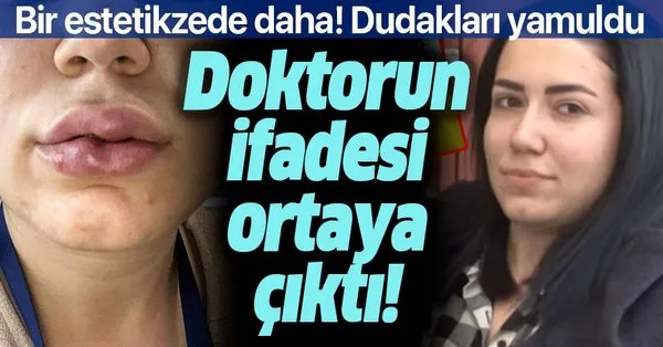 24 Yasindaki Ece Deniz In Dudagi Dolgu Sonrasi Yamuldu Supheli Doktorun Verdigi Ifade Pes Dedirtti Takvim