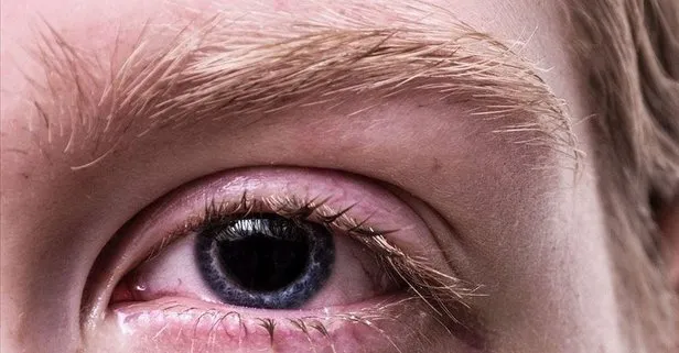 Göz kızarıklığının nedeni ’kuruluk’ olabilir | Göz kuruluğu nedir? Sağlık haberleri