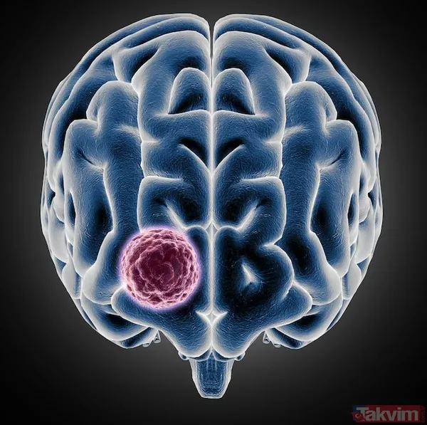 30 saniyelik el testiyle gizli beyin tümörü riski ortaya çıkabilir - 7
