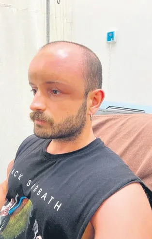 Böyle vaka görülmedi! Nem oranın yüksek olduğu saatlerde güneşlenen gencin kafasında ödem oluştu