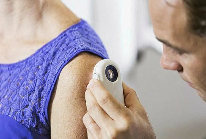 Cilt kanseri sıcak sever