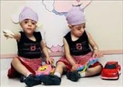 İkiz kardeşlere kopya ameliyat