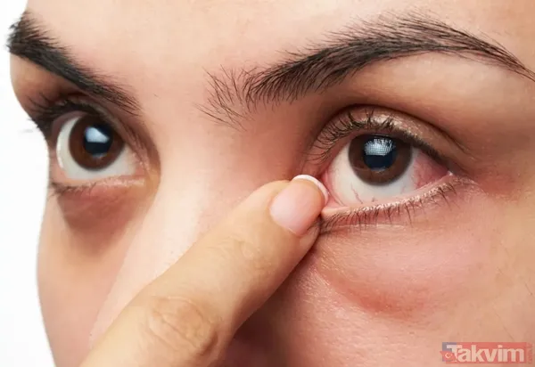 Bu belirtiler sizde de varsa dikkat! Yüzünüz hangi vitamin eksikliğiniz olduğunu söylüyor! - 2