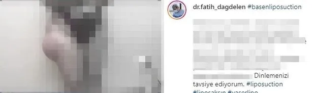 SON DAKİKA: İstanbul'da 'kalça estetiği' faciası: Brezilya kalçası istedi ölümden döndü-7