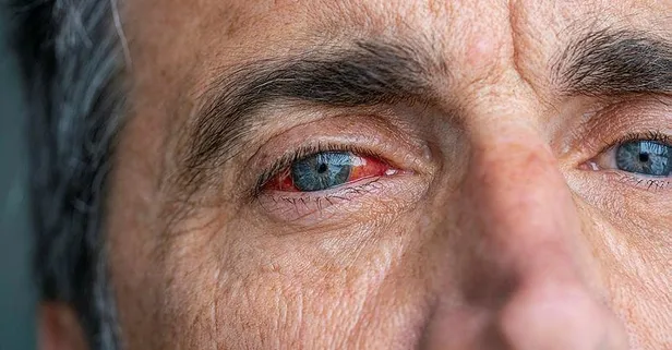 Gözünü seveyim glokom! Tedavi edilmediğinde körlüğe neden oluyor...