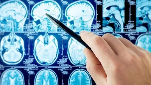 ALS hastalığı nedir? ALS belirtileri nelerdir? ALS tedavisi var mı, nasıl olur?-4