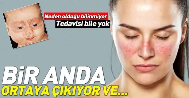 Lupus hastalığı SLE hastalığı nedir? Lupus hastalığı ölümcül müdür?