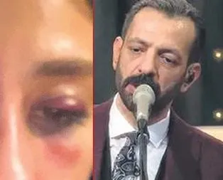Eli çarpmış!