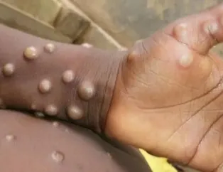 Maymun çiçeği salgını Avrupa’yı vurdu!